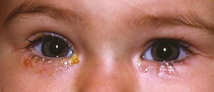泪道阻塞应该如何预防护理?