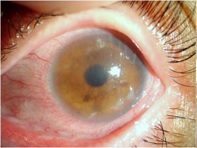 双眼干眼症(移植物抗宿主病)