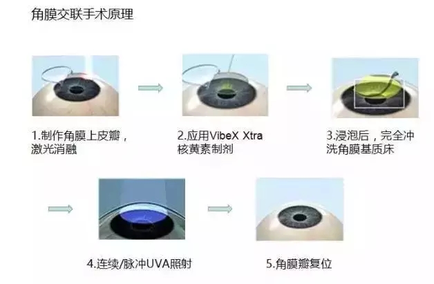 角膜交联技术的应用,主要是有两大类