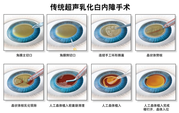 傳統超聲乳化白內障手術過程