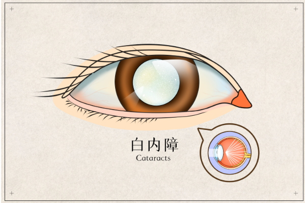 白内障症状