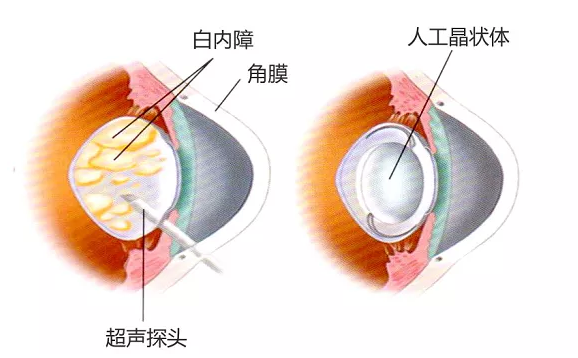 先天性白内障