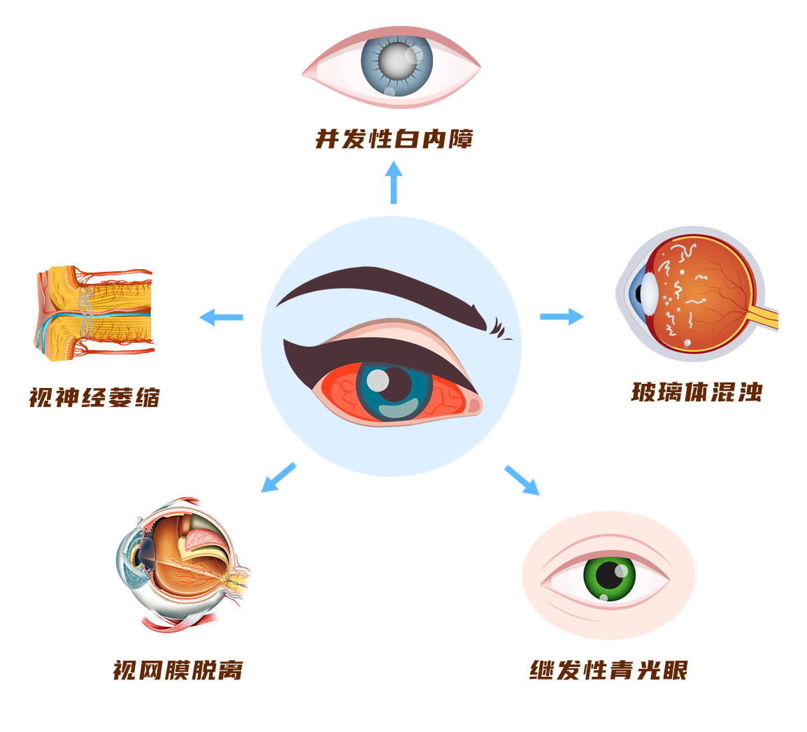 葡萄膜炎并发症